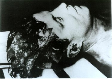 A Side Wound Of Kennedy's Head Wound