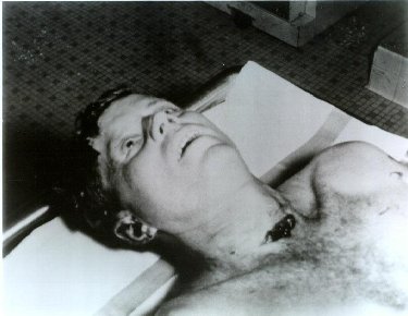 The exit wound on Kennedy's neck